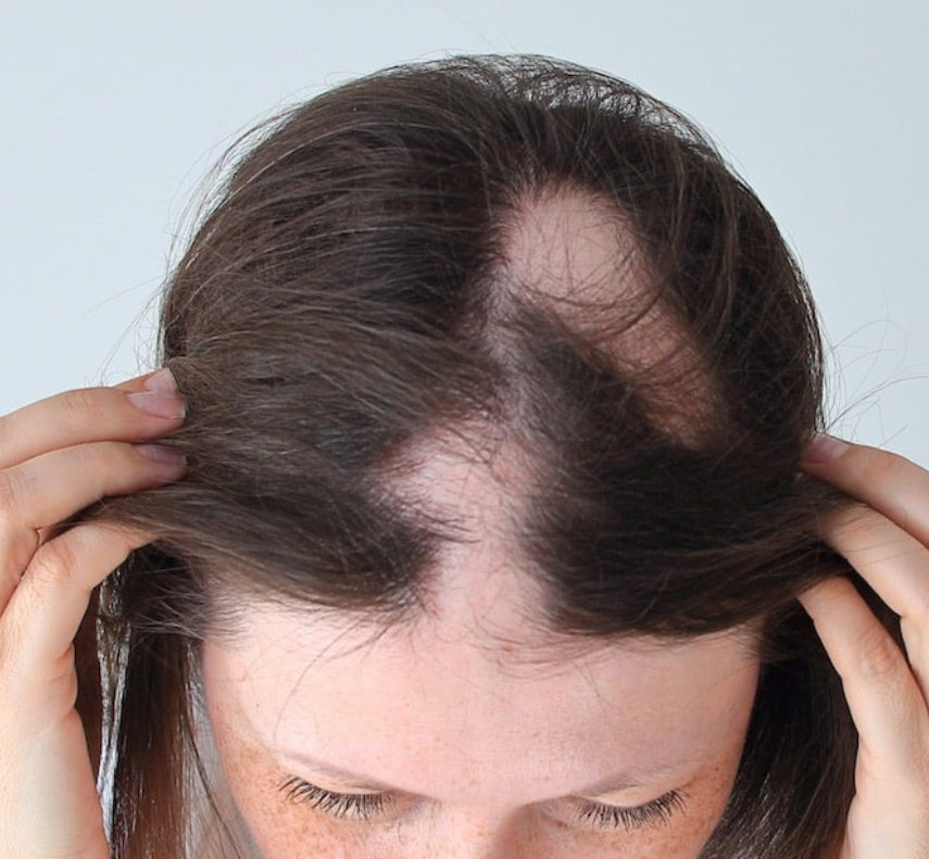 GOTERO ALOPECIA