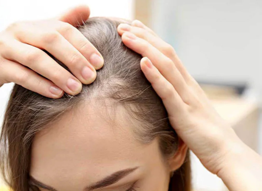 GOTERO ALOPECIA